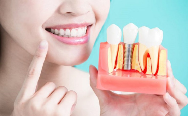 Trồng răng giúp phục hồi khả năng ăn nhai và tính thẩm mỹ