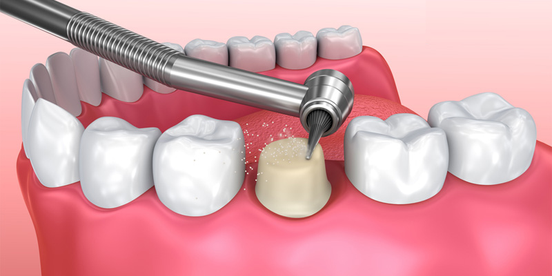 Phương pháp cầu răng sứ bắt buộc phải mài răng để làm cầu sứ