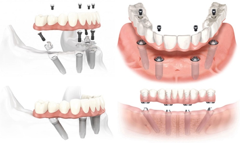 Phương pháp cấy ghép mini implant kết hợp với lắp đặt hàm giả