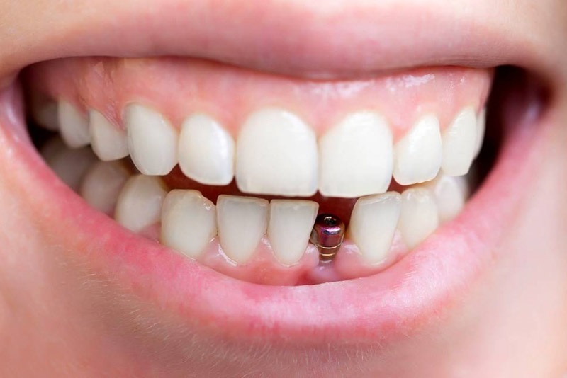 Cấy răng Implant sẽ gây đau trong thời gian cắm trụ Titanium 