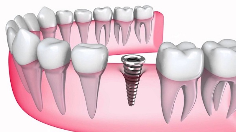 Để răng sứ được vững vàng và cố định, người ta tiến hành cắm trụ implant để làm trụ đỡ chịu lực