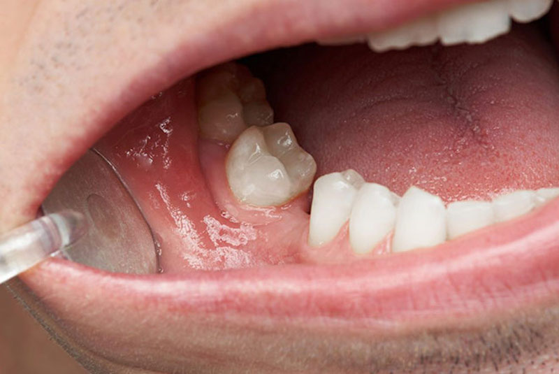 Trồng răng sứ cố định phù hợp nhất với những đối tượng đang bị mất răng do nhiều nguyên nhân