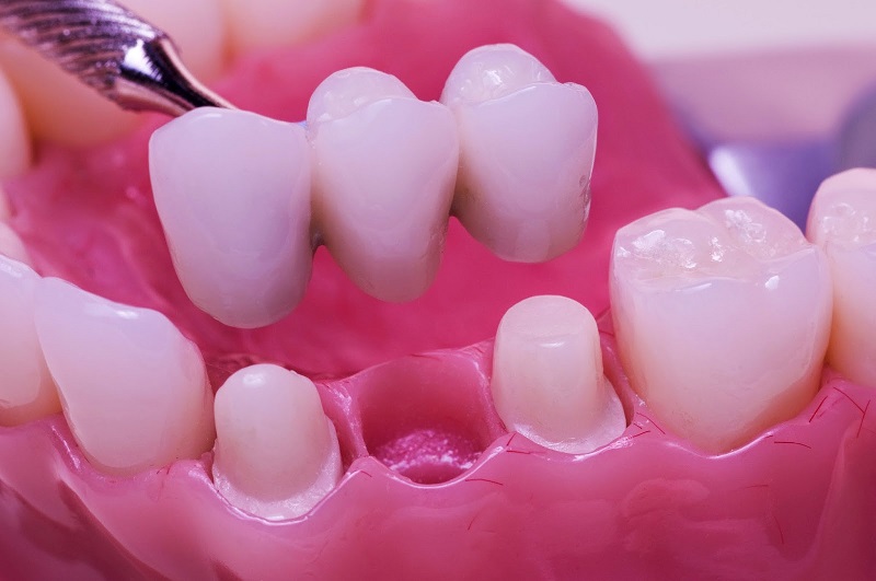 Do phải mài răng thật để làm trụ nên phương pháp cầu răng sứ chắc chắn sẽ gây ê, buốt răng, nhất là đối với người có hàm răng nhạy cảm