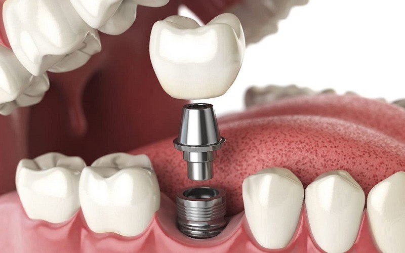 Cấy hép implant là phương pháp trồng răng sứ cố định có giá thành cao nhất