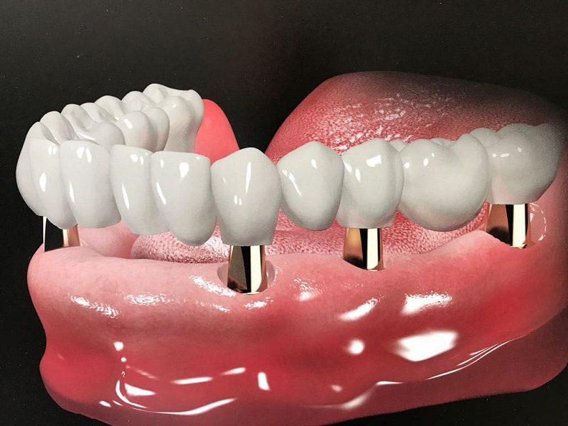 Trồng răng sứ nguyên hàm được áp dụng cho những trường hợp bị mất răng toàn hàm hoặc mất quá nhiều răng trong hàm