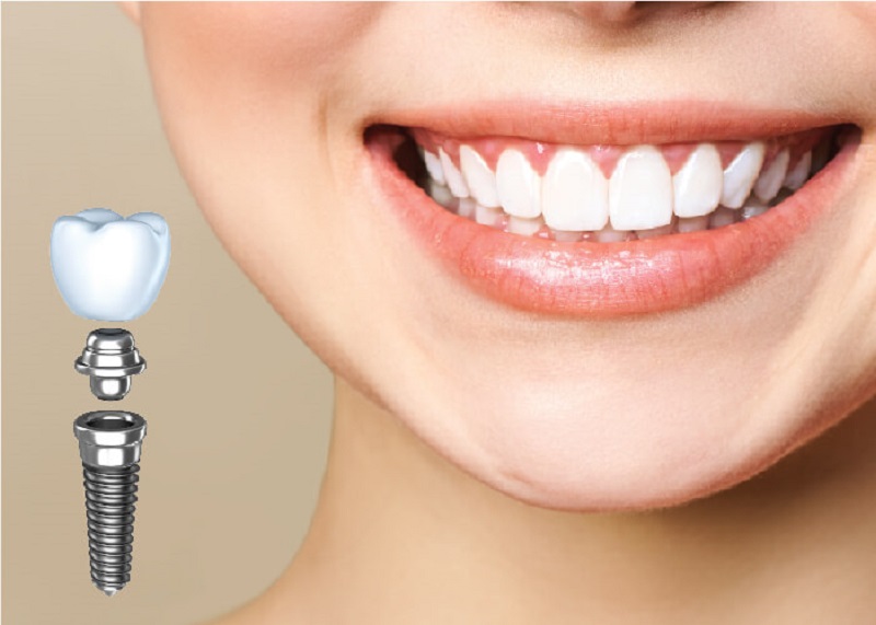 Trồng răng sứ nguyên hàm bằng cấy ghép Implant mang lại hiệu quả tốt hơn so với hàm giả tháo lắp