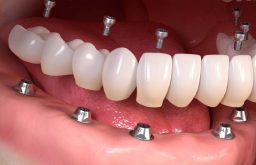trồng răng sứ nguyên hàm