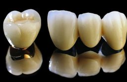 Trồng răng sứ titan là giải pháp nha khoa phục hình thẩm mỹ được quan tâm nhiều hiện nay