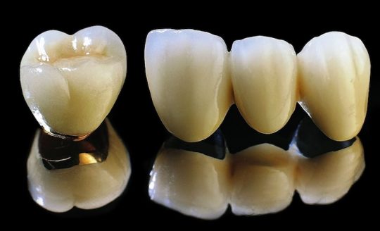 Trồng răng sứ titan là giải pháp nha khoa phục hình thẩm mỹ được quan tâm nhiều hiện nay
