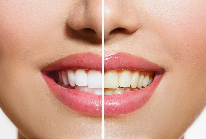 Phương pháp này mang đến một diện mạo hoàn hảo cho hàm răng của bạn
