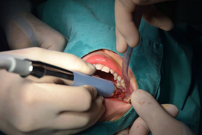 Khi gặp biến chứng sau khi nhổ răng số 8, bạn cần liên hệ với bác sĩ ngay để đảm bảo an toàn