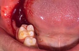 biến chứng sau nhổ răng