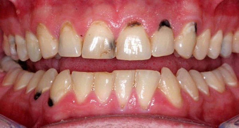 Sâu răng khiến viền chân răng bị đen gây mất thẩm mỹ