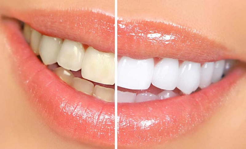 Công nghệ tẩy trắng răng hiện đại mang lại cho bạn một hàm răng trắng sáng, đều màu hơn