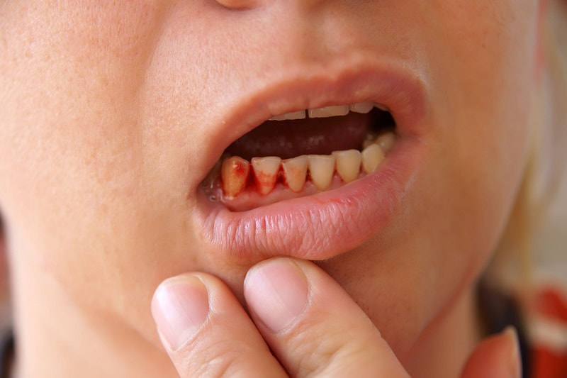 Chảy máu chân răng dù khởi phát từ nguyên nhân nào cũng cần khắc phục sớm