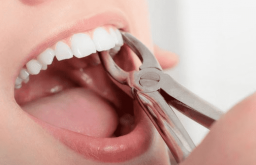 Nhổ răng bao lâu thì trồng răng giả được? Quá trình này có thể cách nhau khoảng từ 2 đến 3 tuần
