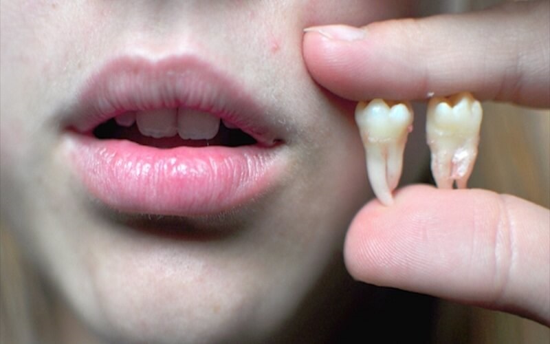 Các trường hợp nhổ răng khôn không cần thiết phải trồng lại răng