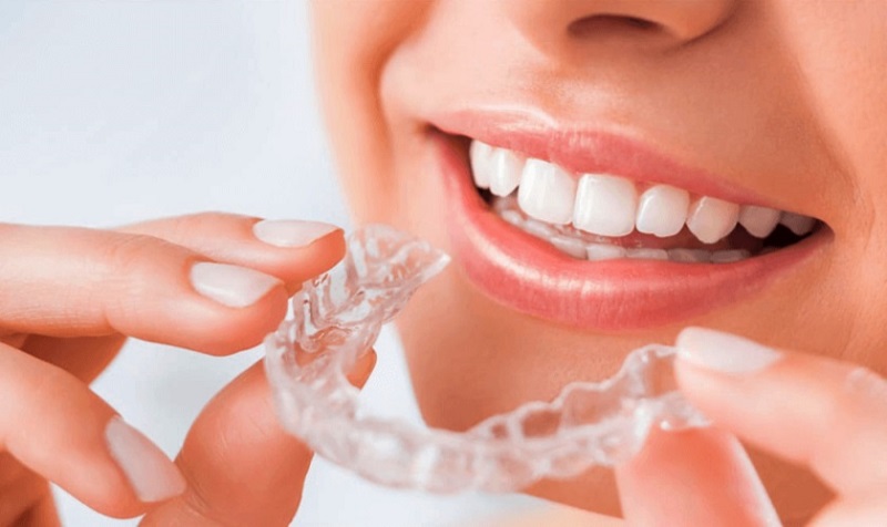 Niềng răng 3D Clear bao nhiêu tiền phụ thuộc nhiều vào tình trạng răng miệng của bạn