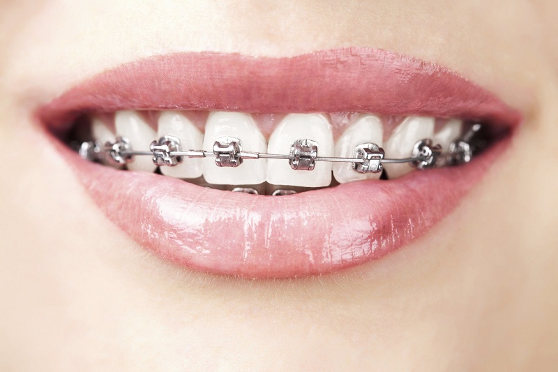 Khí cụ niềng răng cũng ảnh hưởng nhiều đến chi phí chỉnh nha