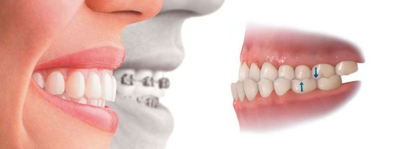 Chi phí niềng răng còn phụ thuộc vào tình trạng sai lệch của khớp cắn