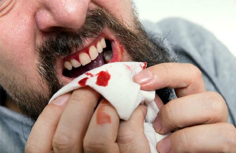 Khi bị chảy máu chân răng nhiều, việc dùng gạc để cầm máu là rất cấp thiết