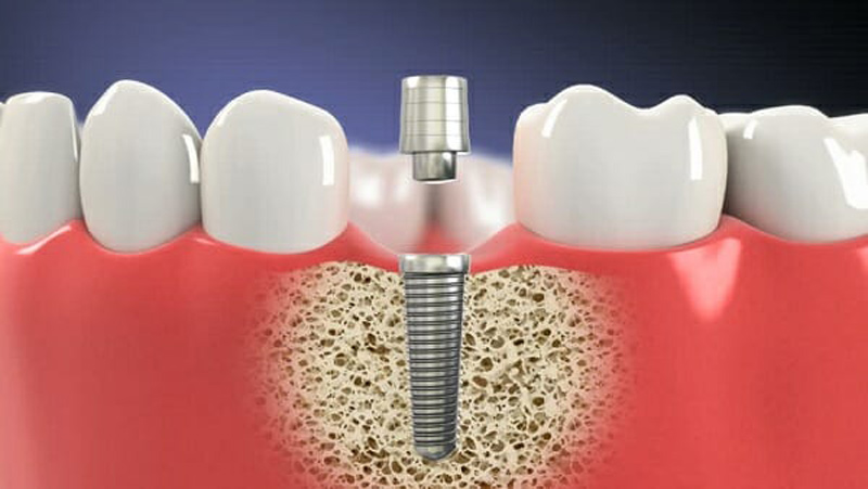 Phẫu thuật cấy ghép trụ Implant vào vị trí răng bị mất là bước phức tạp
