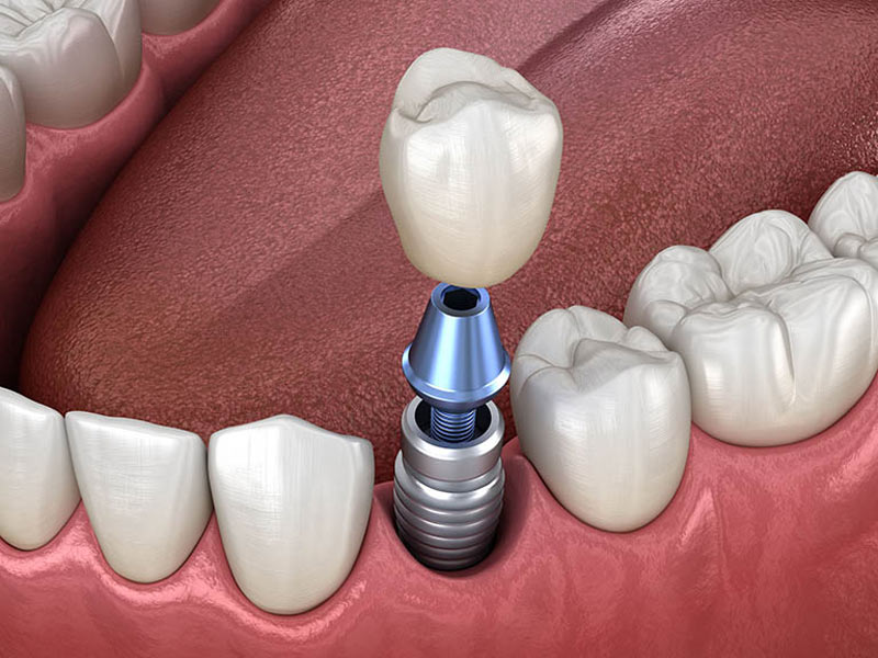 Khi trụ Implant tích hợp xương hàm, bác sĩ sẽ tiến hành lắp răng sứ
