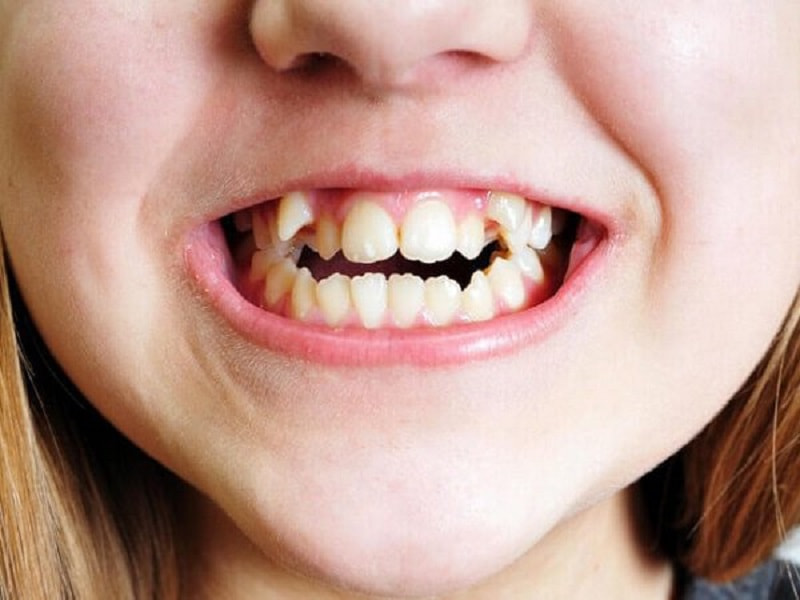 Việc mọc răng 9630 có liên quan nhiều đến yếu tố duy truyền
