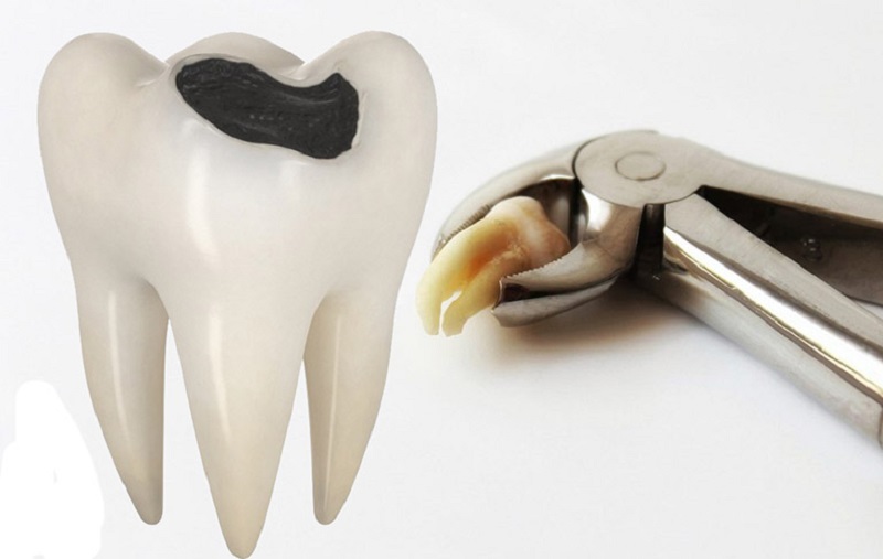 Nhổ răng khôn bị sâu hàm dưới thường khó khăn hơn so với hàm trên