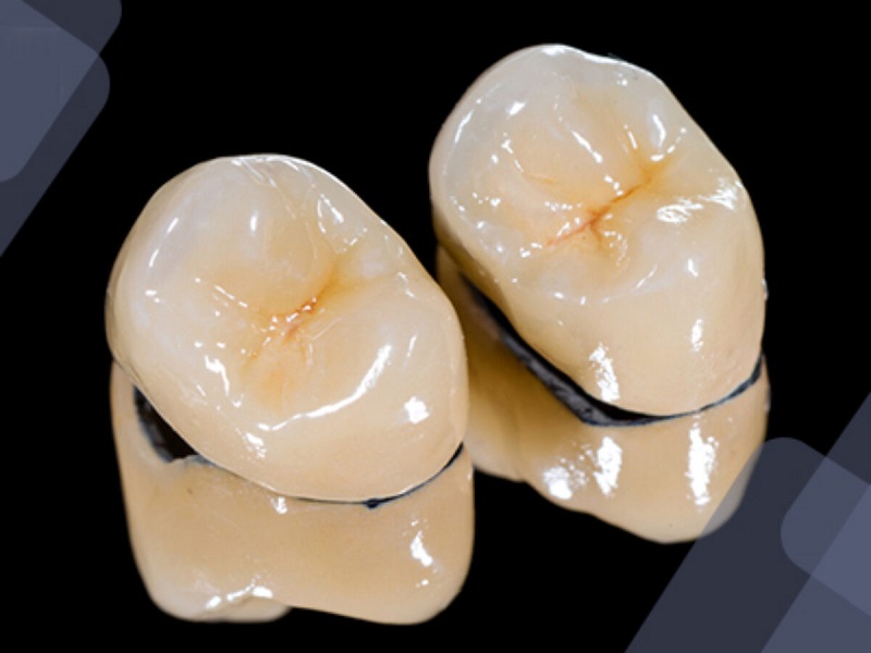 Răng sứ titan có bị đen không là thắc mắc chung của rất nhiều người quan tâm đến chất liệu răng sứ này