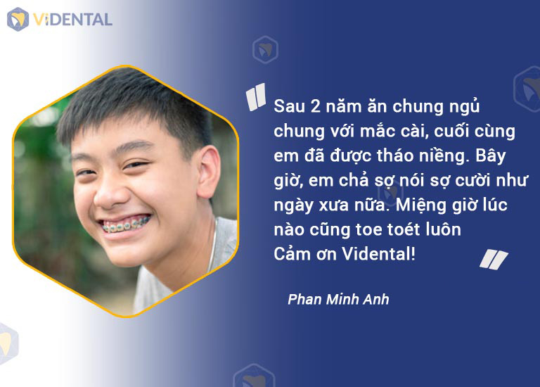 Bạn Phan Minh Anh (sinh viên) phBạn Phan Minh Anh (sinh viên) phản hồi về hiệu quả niềng răng mắc cài kim loại tại ViDentaln hồi về hiệu quả niềng răng mắc cài kim loại tại ViDental