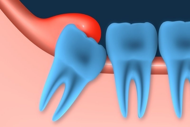 Viêm lợi trùm thường xuất hiện ở vị trí răng trong cùng, tức răng số 7 và số 8