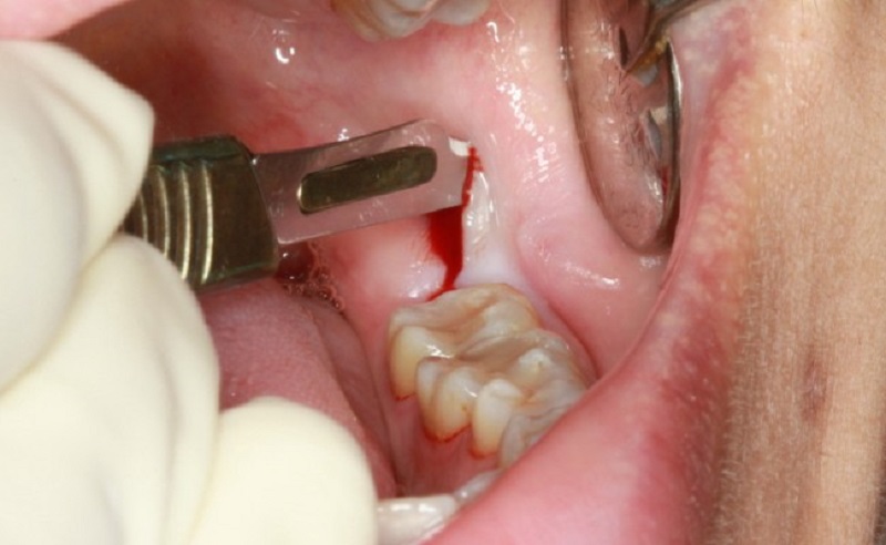 Vùng lợi tại vị trí răng khôn rất dễ bị sưng viêm khi chiếc răng này mọc lên