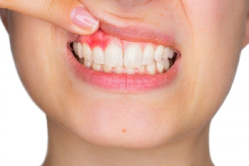 Không nên thực hiện tẩy trắng răng khi răng, lợi đang có bệnh lý