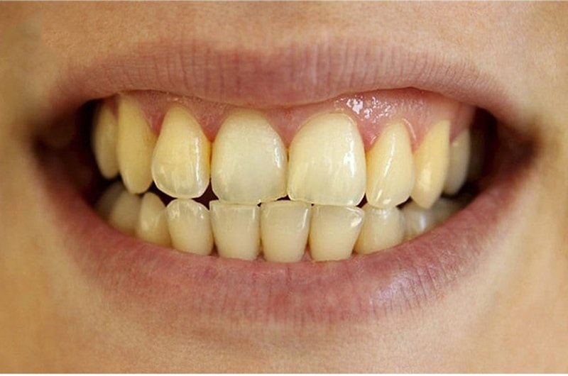 Có rất nhiều nguyên nhân khiến răng bị vàng sau khi tẩy trắng