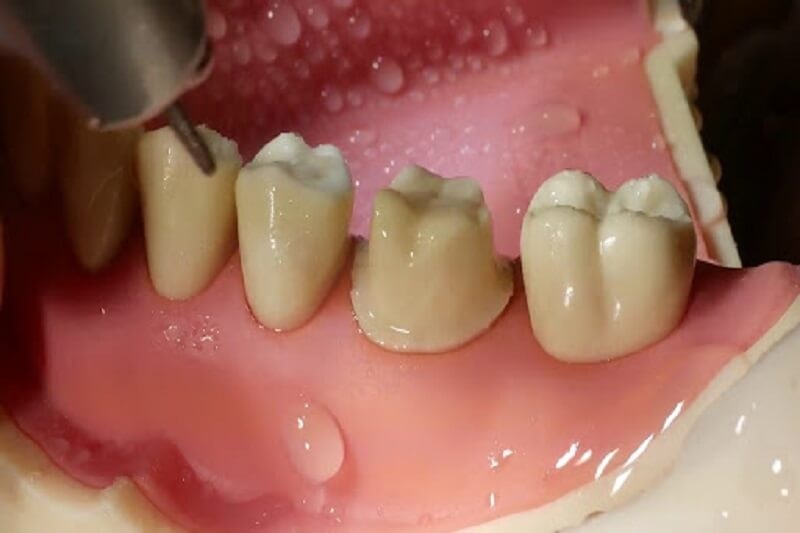 Mài cùi răng là công đoạn quan trọng nhất trong quy trình bắc cầu răng sứ
