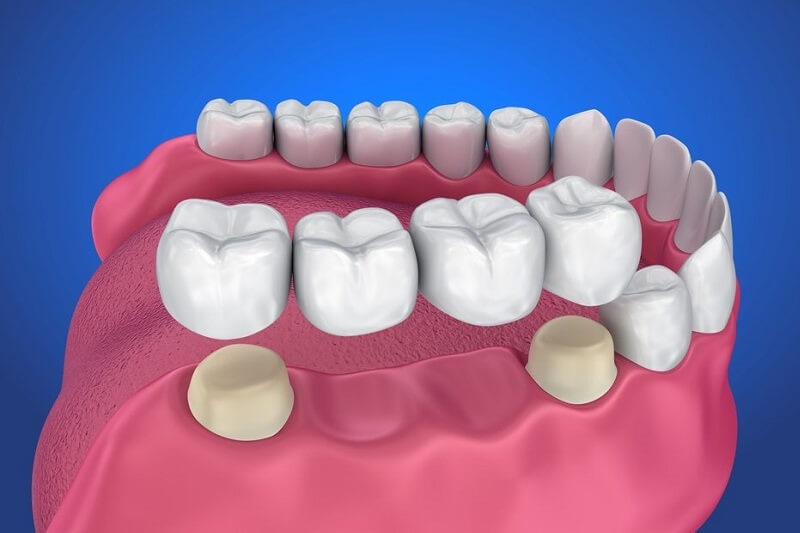 Tuổi thọ của răng sứ bắc cầu có thể lên tới 20 năm nếu bạn biết cách chăm sóc
