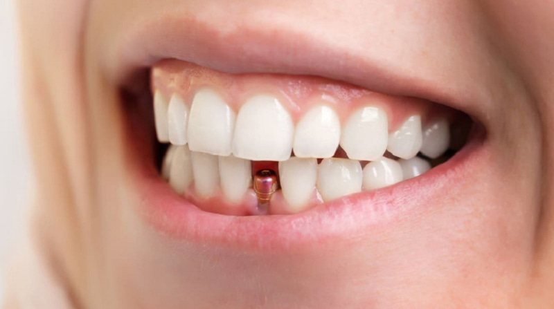 Cấy ghép Implant là phương pháp trồng răng của cố định tốt nhất hiện nay
