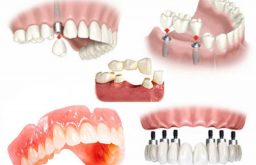 Trồng răng là giải pháp được nhiều người lựa chọn để cải thiện thẩm mỹ và chức năng ăn nhai