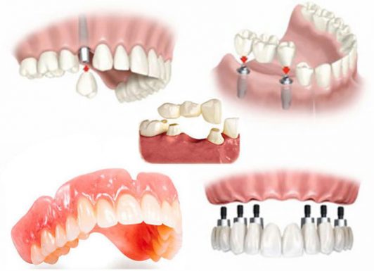 Trồng răng là giải pháp được nhiều người lựa chọn để cải thiện thẩm mỹ và chức năng ăn nhai
