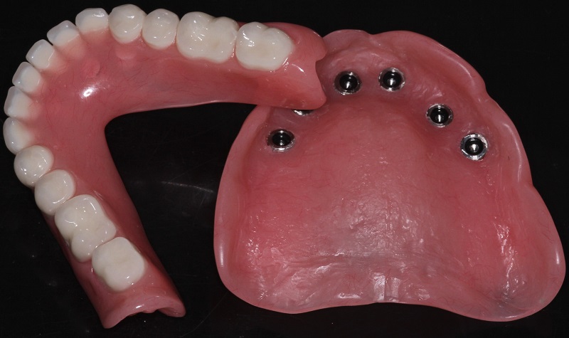 Răng giả tháo lắp trên Implant có độ bền cao