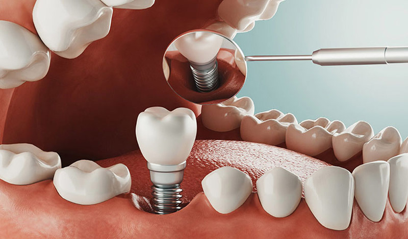 Khi răng thật bị mất hoàn toàn, bạn sẽ được bác sĩ khuyên trồng răng giả vĩnh viễn
