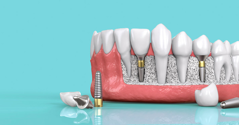 Cấy ghép Implant được xem là phương pháp hiệu quả nhất khi trồng răng giả vĩnh viễn