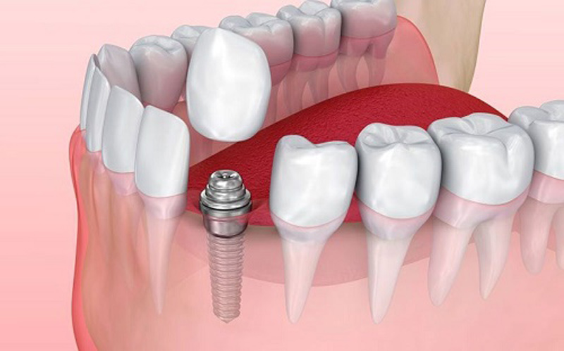 Quá trình trồng răng Implant sẽ hoàn thiện sau khi bác sĩ gắn răng sứ lên phía trên Abutment