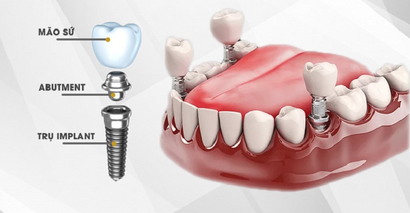 Chi phí trồng răng Implant có thể dao động từ 10.000.000 - 40.000.000 VNĐ/răng