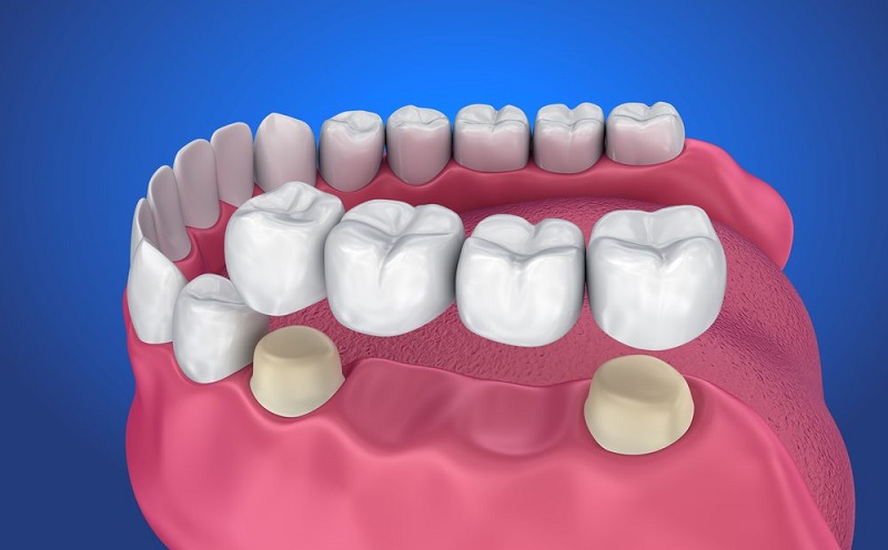 Mài cùi răng là thao tác bắt buộc để phục hình răng đã mất bằng cầu răng sứ