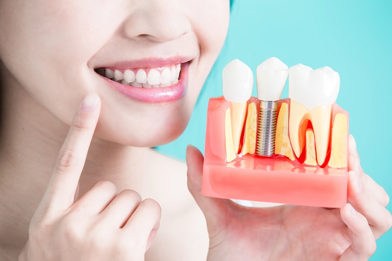 Cấy ghép Implant là phương pháp trồng răng hàm giả tốt nhất hiện nay