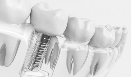 Trồng răng implant có đau không là nỗi lo lắng của rất nhiều người trước khi quyết định thực hiện