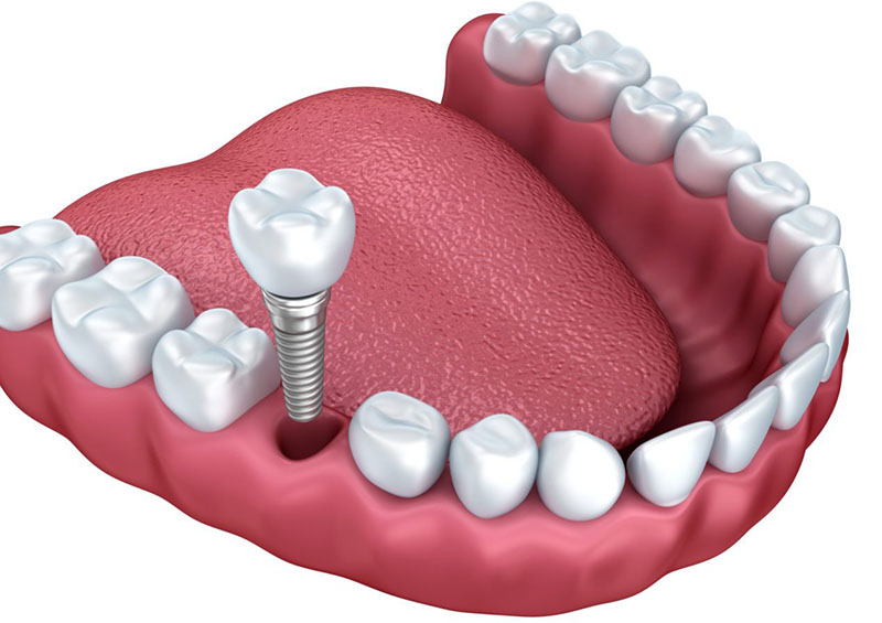 Trồng răng implant có nguy hiểm không là thắc mắc chung của rất nhiều người bệnh 