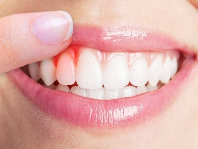 Chảy máu chân răng là biến chứng bạn có thể gặp nếu thực hiện không đúng cách